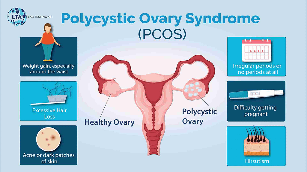 PCOS and hirsutism